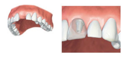 Zubni implantati
